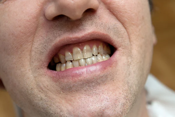 Homem com dentes amarelos. O dano do conceito de tabaco . — Fotografia de Stock