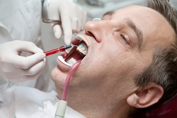 歯を白くする歯科医のオフィスでプロセスの最中に男 — ストック写真