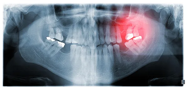 Radiografie dentali panoramiche — Foto Stock