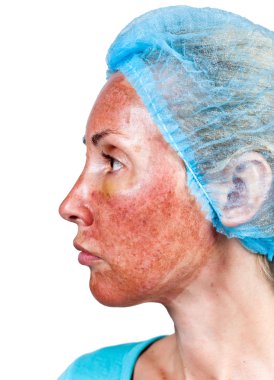 kozmetik. kimyasal peeling tca.top katman yaktıktan sonra durum cilt