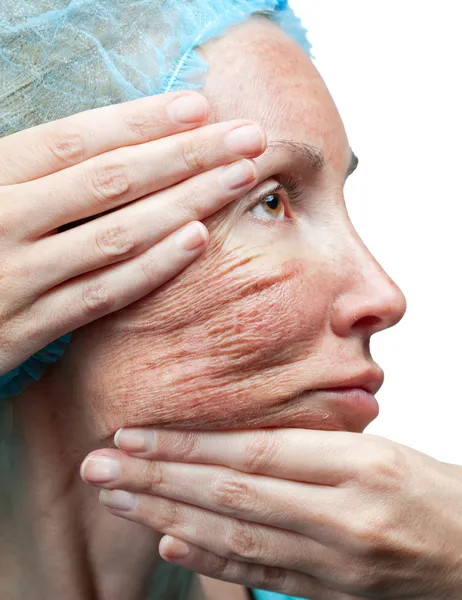 Kosmetologi. kemisk peeling. "pergament" huden innan avslag — Stockfoto