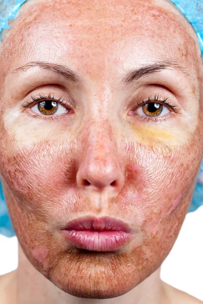 kozmetik. kimyasal peeling. 