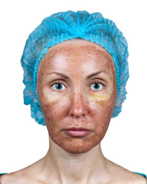 Kosmetologia. peeling chemiczny. "pergamin" skóry przed odrzuceniem — Zdjęcie stockowe