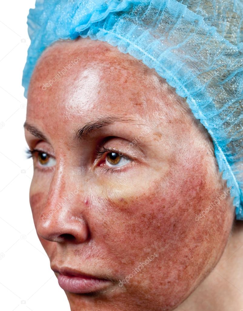 Cosmetology. Skin condition after chemical peeling TCA. The beginning of tearing away of the top burned layer,