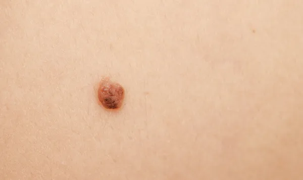 Mole on skin — Stock Photo, Image