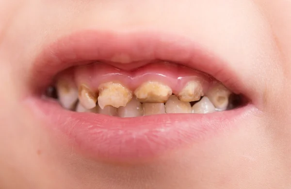 悪い歯 — ストック写真