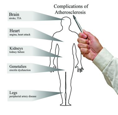 ateroskleroz komplikasyonlar
