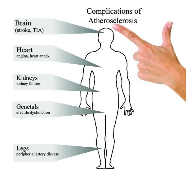 Complications of Atherosclerosis — Stock Photo, Image