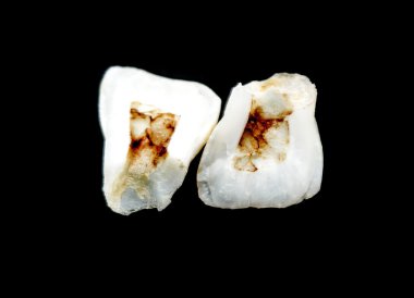 insan diş çürüğü ile