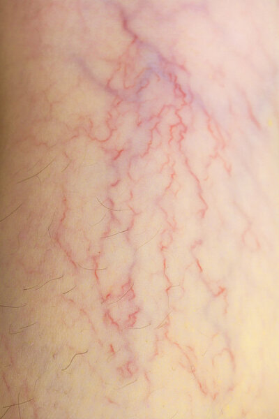 Varicose veins