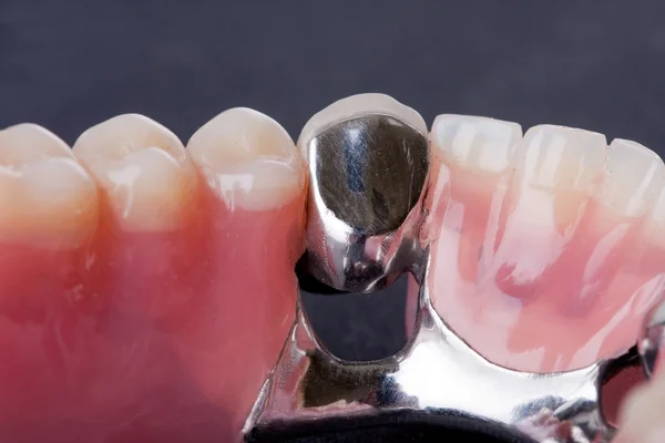 Dental wax model — Stock Photo, Image