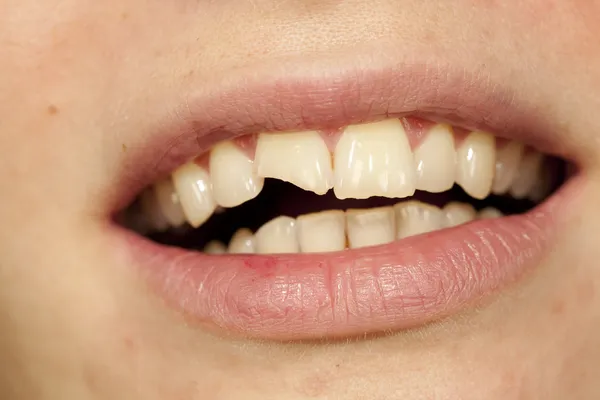 Broken tooth — Stock Photo, Image