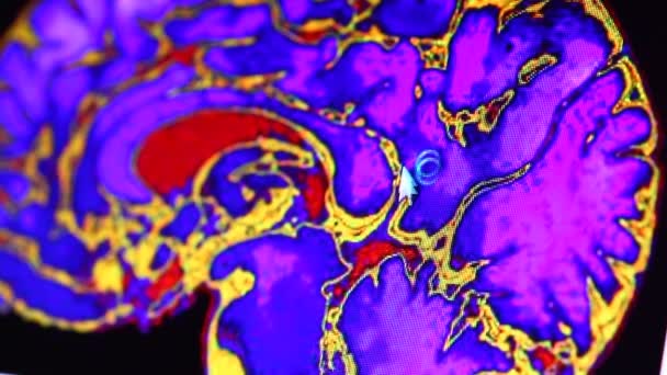 Exploración por resonancia magnética en el monitor del ordenador — Vídeo de stock