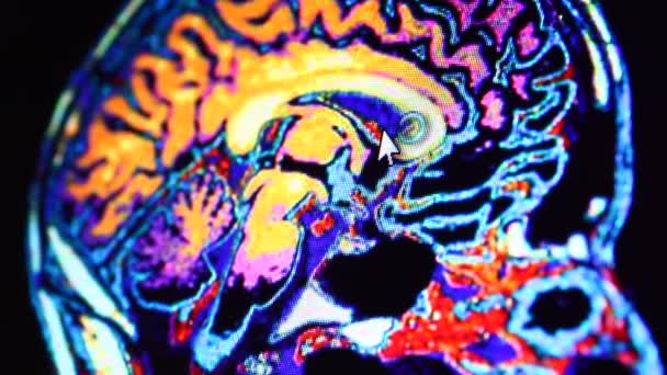 MRI tarama bilgisayar monitör üzerinde — Stok video