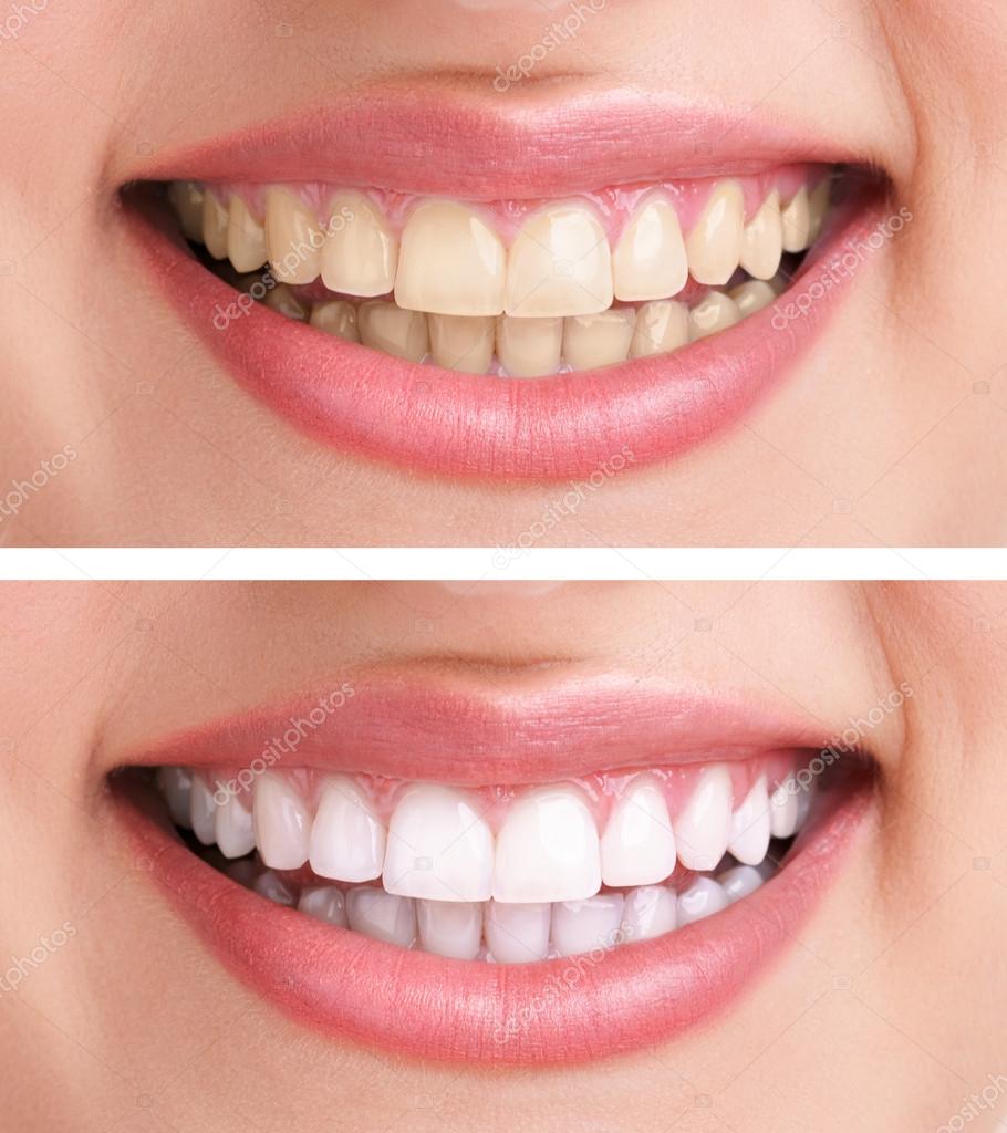Whitening - bleaching treatment ,before and after ,woman teeth and smile, close up, isolated on white