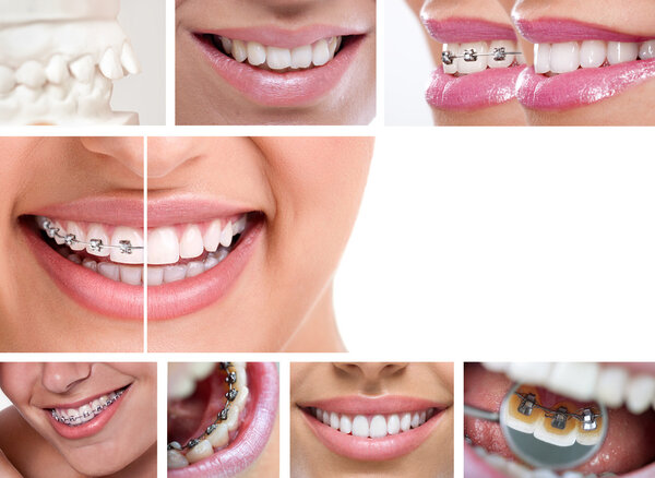 dental braces