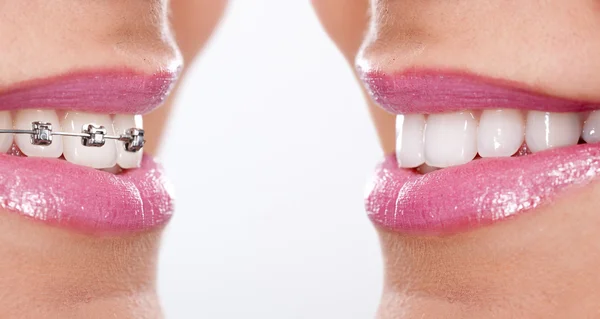 Teeth with braces — Stock Photo, Image