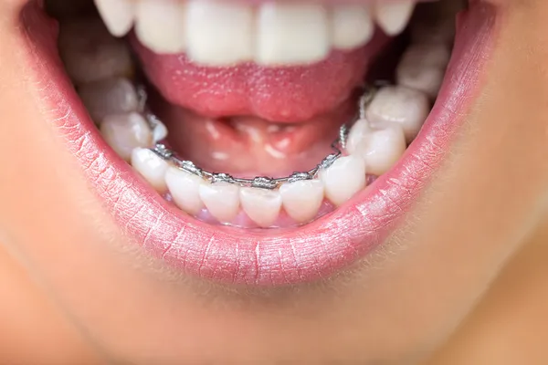 Close up of lingual braces — https://st.depositphotos.com/1004713/3188/i/450/depositphotos_31884671-stock-photo-close-up-of-lingual-braces.jpg
