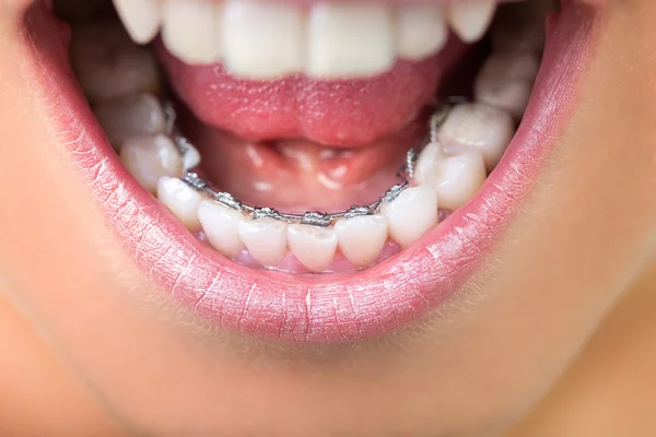 Close up of lingual braces — Stock Photo, Image