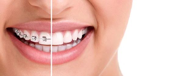 Gesundes Lächeln mit Zahnspange lizenzfreie Stockbilder