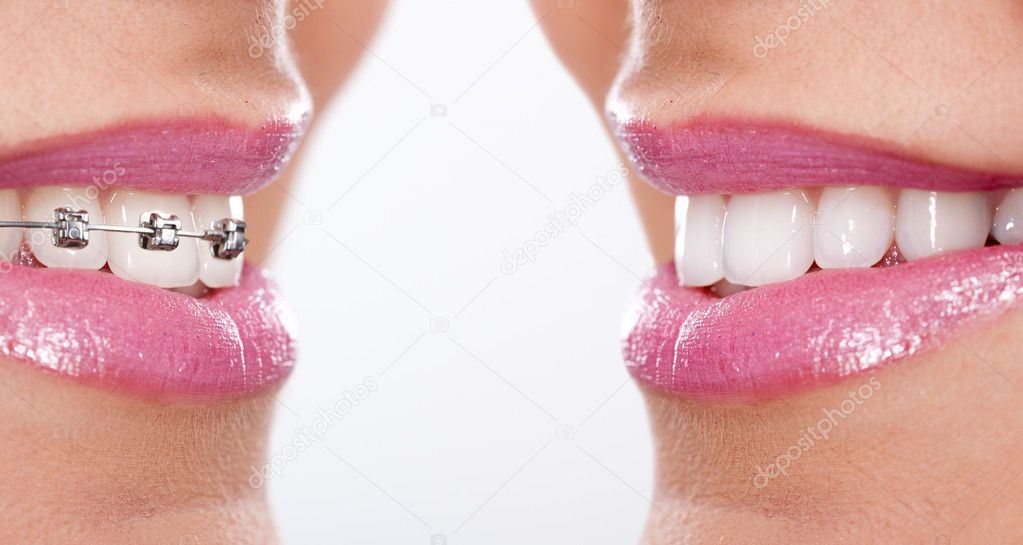 Teeth with braces — Stock Photo © luckybusiness 31884341