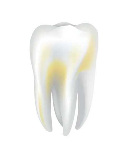 Dente humano enfeitiçado. Ícone do vetor médico dentário. Precisa de cuidados dentários para dentes manchados ou cárie dentária. Restauração dos dentes orais —  Vetores de Stock