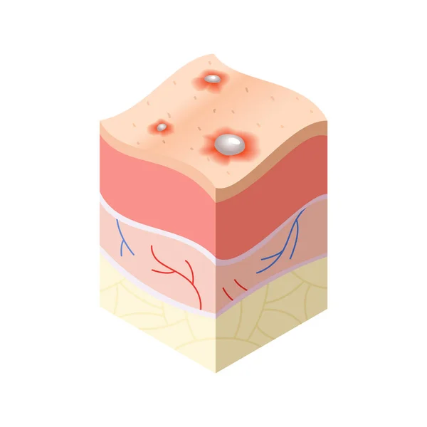 Concepto médico del cuidado de la piel. Problemas en la sección transversal de la estructura de capas horizontales de la piel humana. Modelo ilustrativo de anatomía — Vector de stock