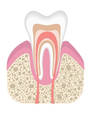 Sağlıklı diş bakterilerle enfekte olmaz. Caries Development 'ın ilk aşaması. Düz bir diş yapısı var. Diş mineli. Gerçekçi vektör illüstrasyonu