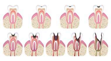 Kariyer geliştirme aşamaları. Düz bir diş yapısı var. Diş minesiyle çürür. Diş hastalıkları, pulpitis ve periodontitis, gerçekçi vektör illüstrasyonu.
