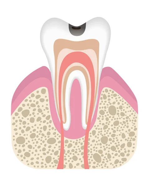 Fase Desarrollo Caries Estructura Los Dientes Estilo Plano Caries Dental — Vector de stock