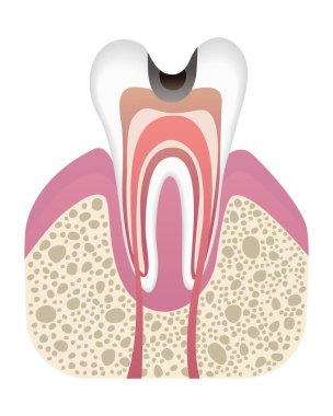 Caries geliştirme aşaması. Düz bir diş yapısı var. Diş minesiyle çürür. Diş hastalıkları gerçekçi vektör çizimi.