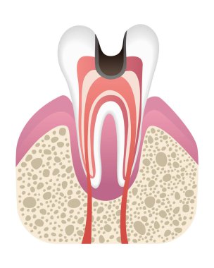 Caries geliştirme aşaması. Düz bir diş yapısı var. Diş minesiyle çürür. Diş hastalıkları gerçekçi vektör çizimi.