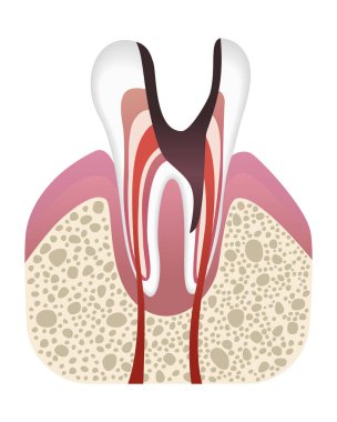 Caries geliştirme aşaması. Düz bir diş yapısı var. Diş minesiyle çürür. Diş hastalıkları gerçekçi vektör çizimi.