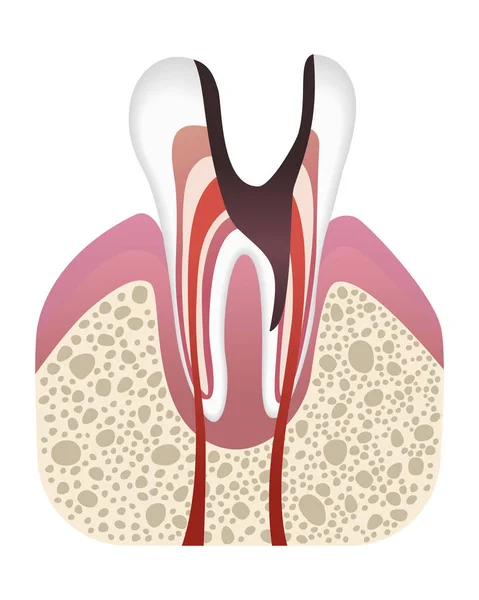 キャリア開発の段階 平らなスタイルで歯の構造 エナメルで歯が腐る 歯科疾患リアルなベクトル図 — ストックベクタ