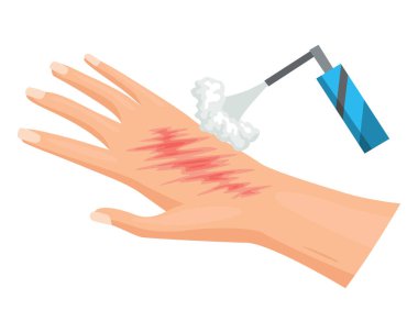 Hands injured skin and procedures of wound cleaning. First aid for wound. Medicine cure or treatment. First emergency help for human hand trauma.