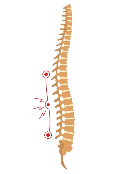 Deformidad Espinal Símbolo Curvaturas Columna Vertebral Espinas Insalubres Anatomía Columna — Vector de stock