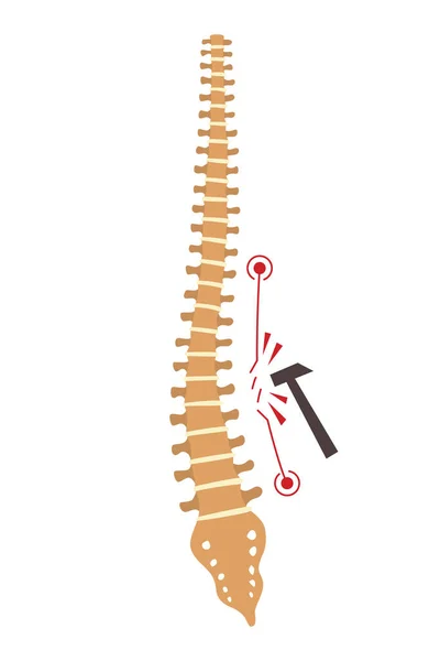 Spinal Deformity Symbol Spine Curvatures Unhealthy Backbones Human Spine Anatomy — Stock Vector