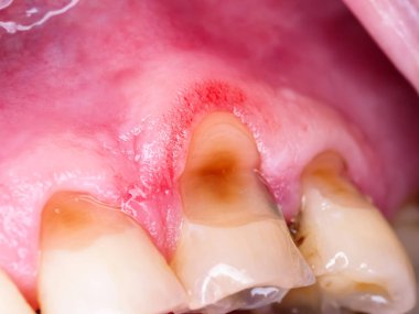 decayed caries teeth man close up
