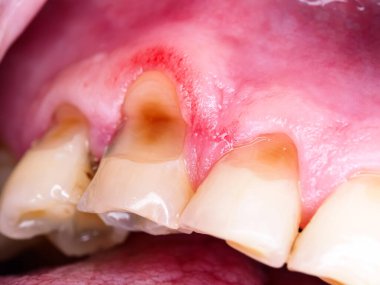 decayed caries teeth man close up