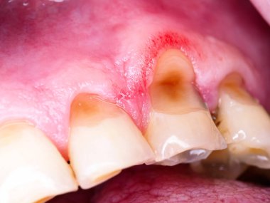 decayed caries teeth man close up