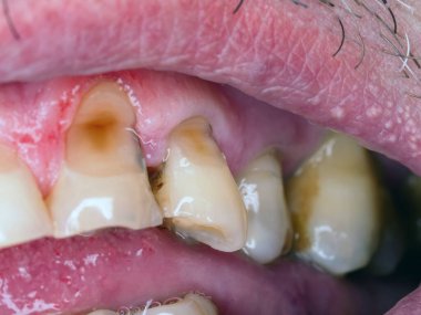 decayed caries teeth man close up