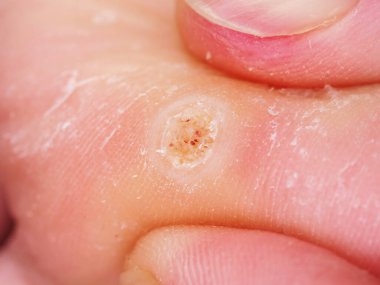 Ayakta nasır büyümesi var.