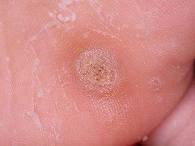 Ayakta nasır büyümesi var.