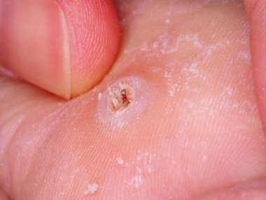 Ayakta nasır büyümesi var.