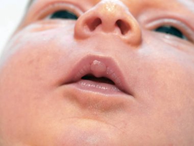 emzirme yüzünden bebeğin üst dudağındaki nasır.