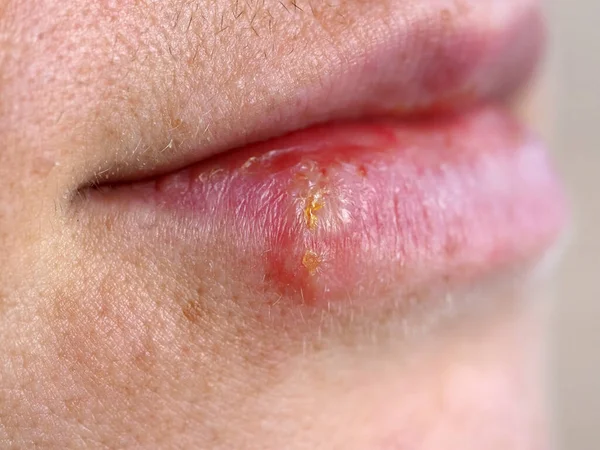 Herpes Labio Una Mujer — Foto de Stock