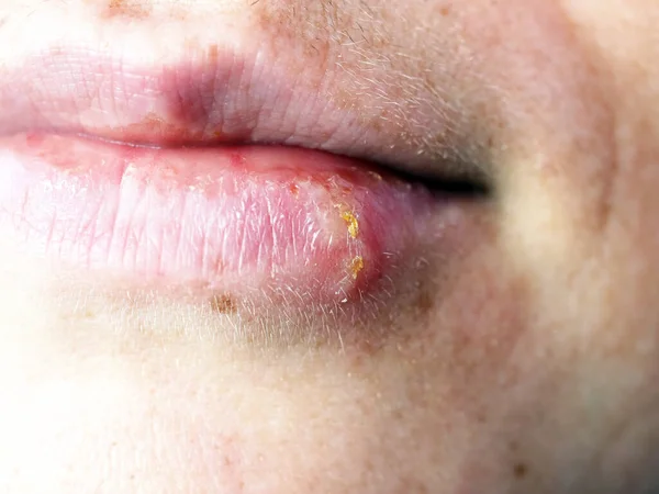 女人嘴唇上的疱疹 — 图库照片