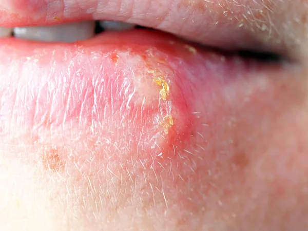 Herpes Lábio Uma Mulher — Fotografia de Stock