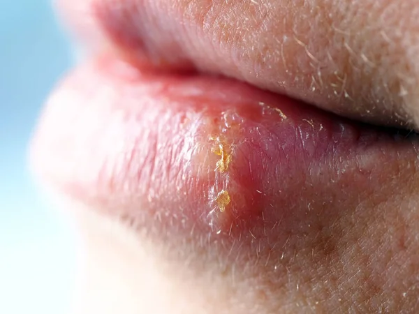 Herpes Labio Una Mujer — Foto de Stock