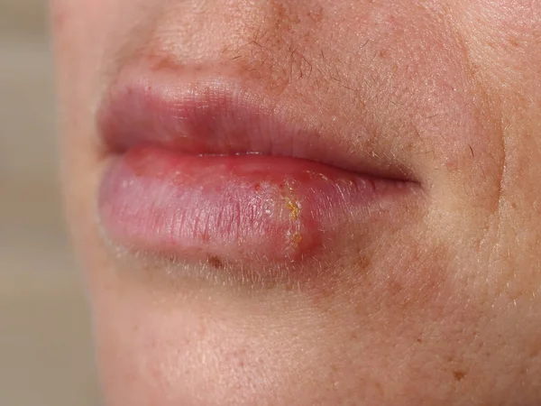 Herpes Lábio Uma Mulher — Fotografia de Stock